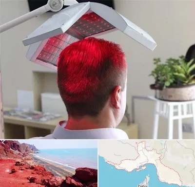 کاشت مو با لیزر در هرمزگان