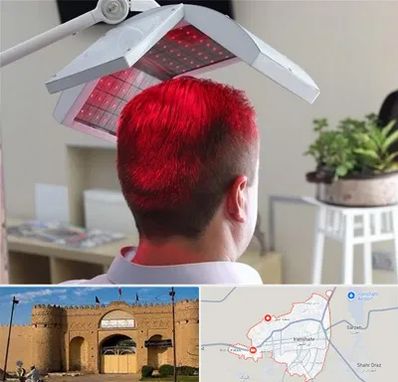 کاشت مو با لیزر در ایرانشهر
