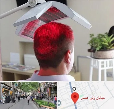 کاشت مو با لیزر در ولیعصر شهریار