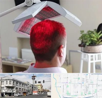 کاشت مو با لیزر در 17شهریور