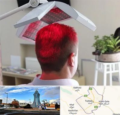 کاشت مو با لیزر در تایباد