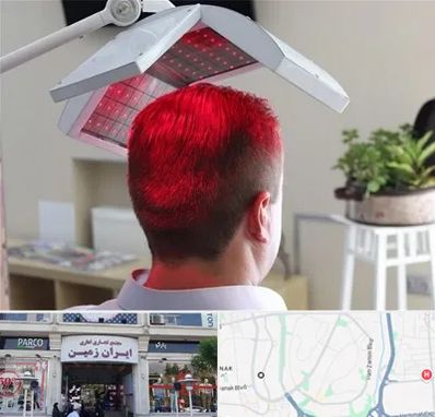 کاشت مو با لیزر در ایران زمین