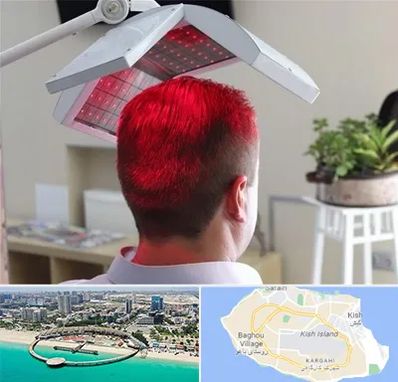 کاشت مو با لیزر در کیش