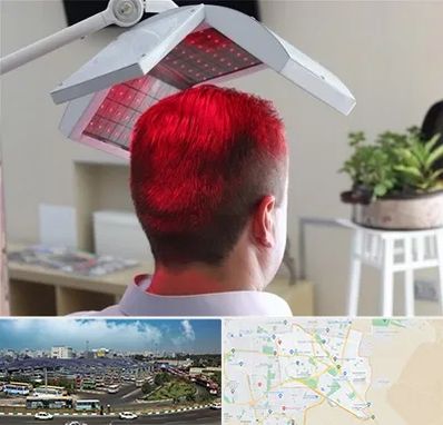 کاشت مو با لیزر در منطقه 15 تهران 