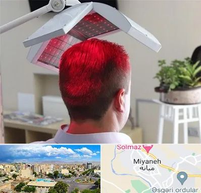 کاشت مو با لیزر در میانه