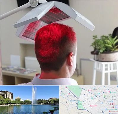 کاشت مو با لیزر در کوهسنگی مشهد