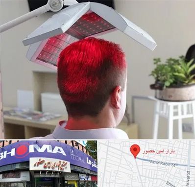 کاشت مو با لیزر در امین حضور