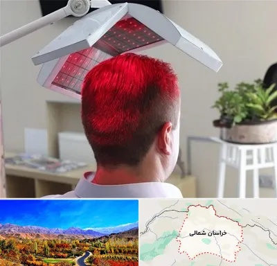 کاشت مو با لیزر در خراسان شمالی