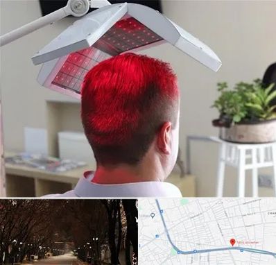 کاشت مو با لیزر در ابوریحان تبریز