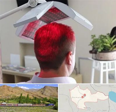 کاشت مو با لیزر در خاش