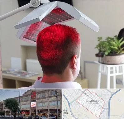 کاشت مو با لیزر در قائمیه اسلامشهر