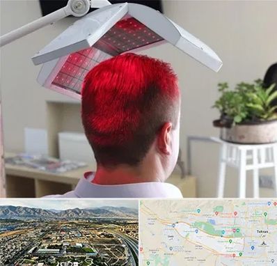 کاشت مو با لیزر در منطقه 21 تهران 