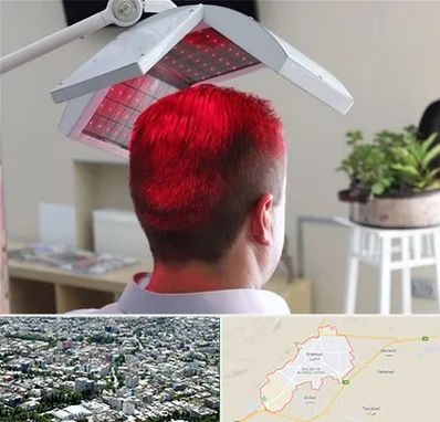 کاشت مو با لیزر در شاهرود