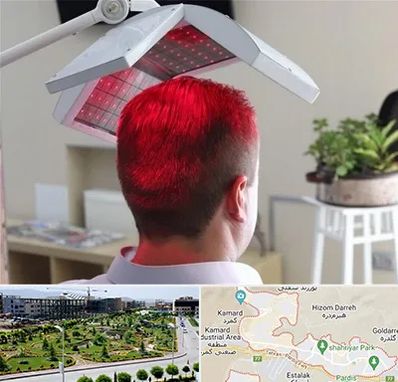 کاشت مو با لیزر در پردیس