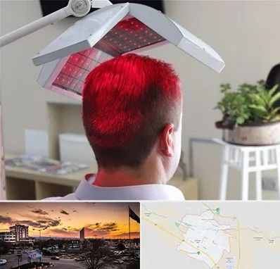 کاشت مو با لیزر در قوچان