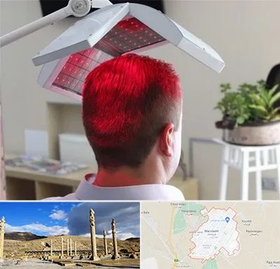 کاشت مو با لیزر در مرودشت