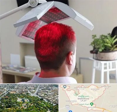 کاشت مو با لیزر در شهرکرد