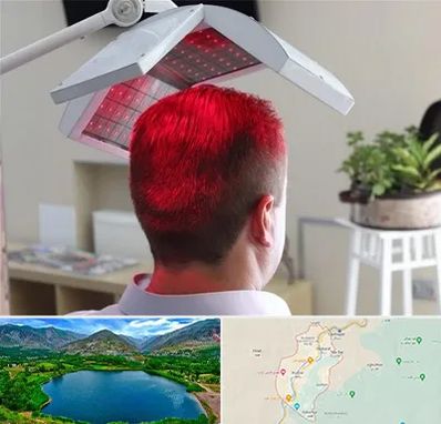 کاشت مو با لیزر در رودبار