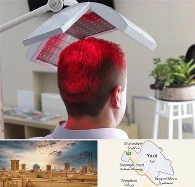 کاشت مو با لیزر در یزد