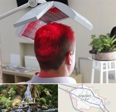 کاشت مو با لیزر در الیگودرز