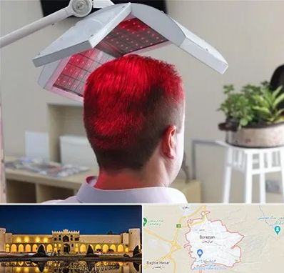 کاشت مو با لیزر در برازجان