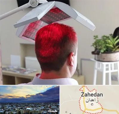 کاشت مو با لیزر در زاهدان