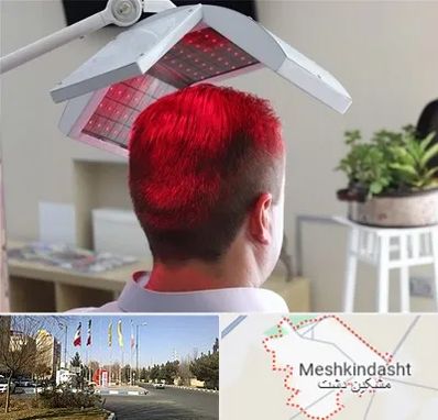 کاشت مو با لیزر در مشکین دشت