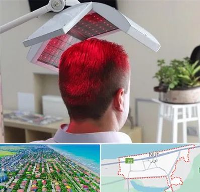 کاشت مو با لیزر در نور