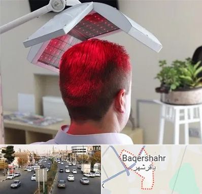 کاشت مو با لیزر در باقرشهر