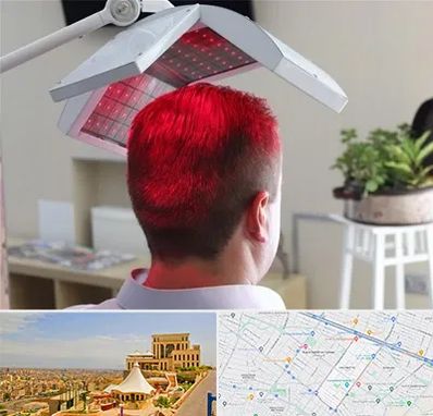 کاشت مو با لیزر در هاشمیه مشهد