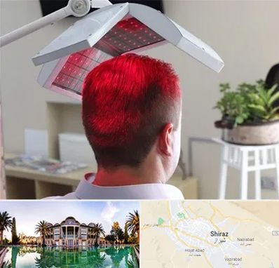 کاشت مو با لیزر در شیراز