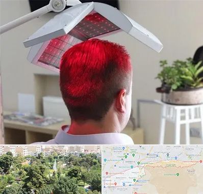 کاشت مو با لیزر در منطقه 13 تهران 