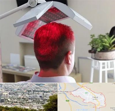 کاشت مو با لیزر در یاسوج