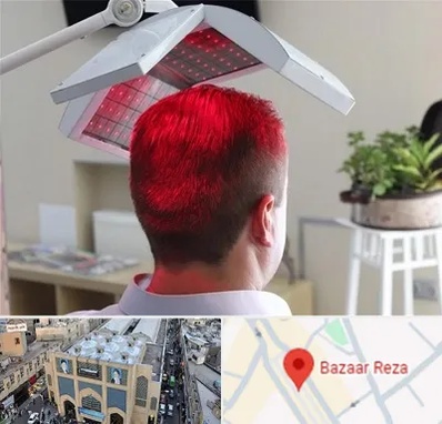 کاشت مو با لیزر در بازار رضا مشهد