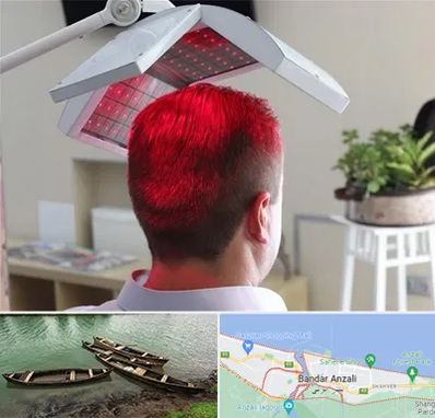 کاشت مو با لیزر در بندر انزلی