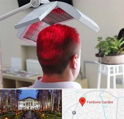 کاشت مو با لیزر در باغ فردوس