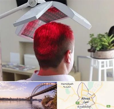 کاشت مو با لیزر در اهواز