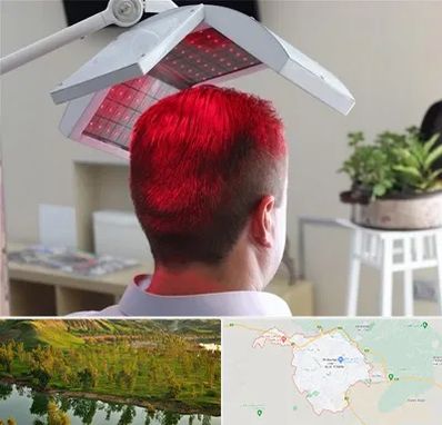 کاشت مو با لیزر در بهبهان