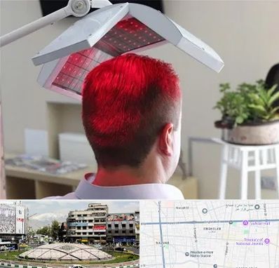 کاشت مو با لیزر در مرکز تهران