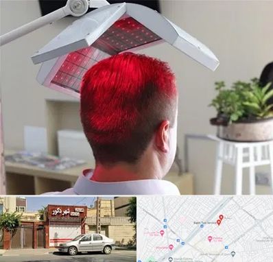 کاشت مو با لیزر در باجک قم