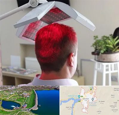 کاشت مو با لیزر در مهاباد