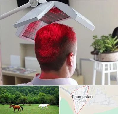 کاشت مو با لیزر در چمستان