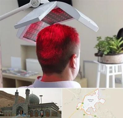 کاشت مو با لیزر در شهرضا