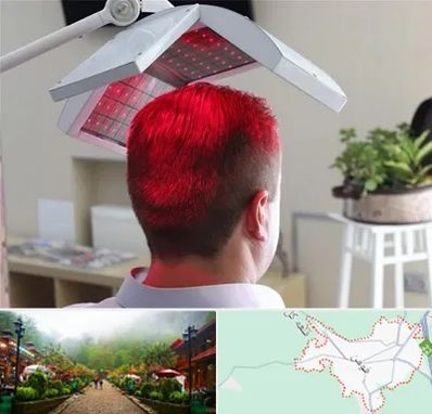 کاشت مو با لیزر در فومن