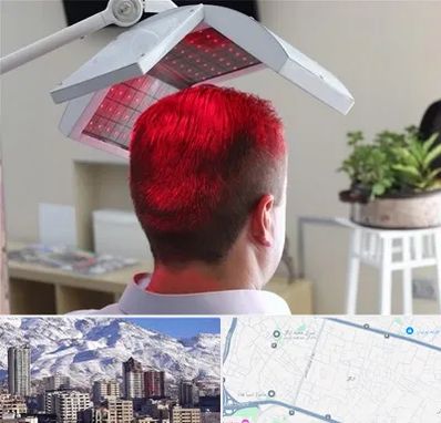 کاشت مو با لیزر در ازگل