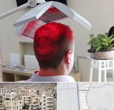 کاشت مو با لیزر در اسکندری