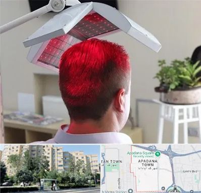 کاشت مو با لیزر در آپادانا