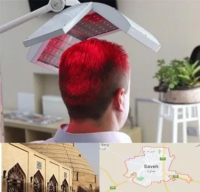 کاشت مو با لیزر در ساوه