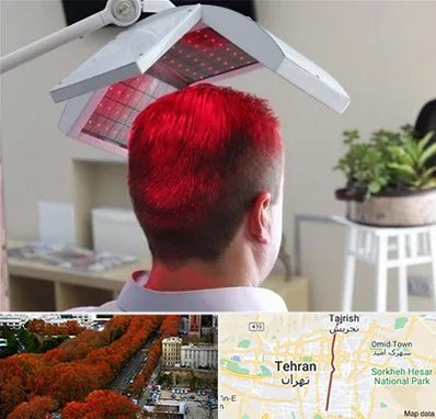 کاشت مو با لیزر در ولیعصر 