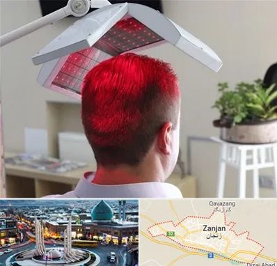 کاشت مو با لیزر در زنجان